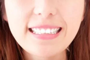差し歯の黄ばみはホワイトニングでは取れません