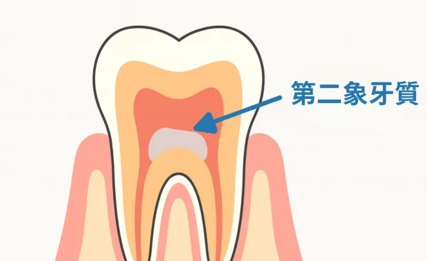 第二象牙質