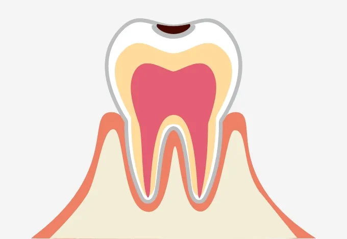 表面のエナメル質に穴が空いた虫歯