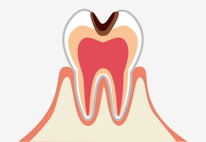 歯の内部まで進行した虫歯