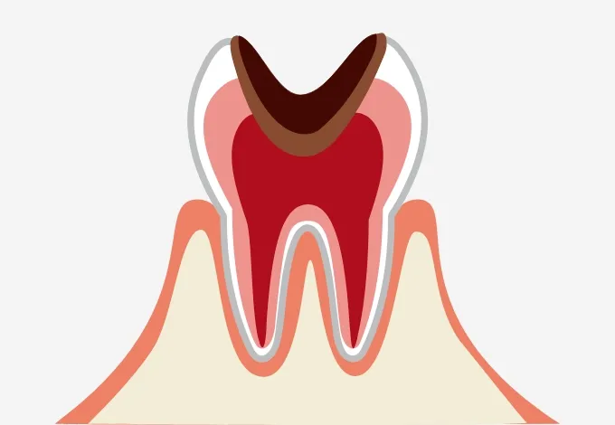 歯髄（神経）まで進行した虫歯